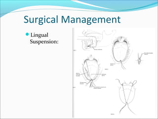 Surgical Management
Lingual
Suspension:
 