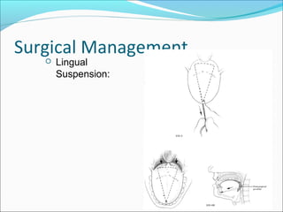 Surgical Management
 Lingual
Suspension:
 