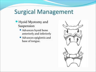 Surgical Management
Hyoid Myotomy and
Suspension
Advances hyoid bone
anteriorly and inferiorly
Advances epiglottis and
base of tongue.
 