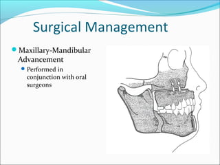Surgical Management
Maxillary-Mandibular
Advancement
Performed in
conjunction with oral
surgeons
 