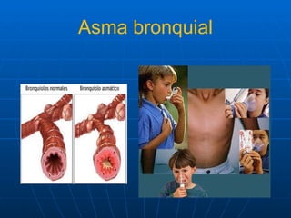 Asma bronquial 