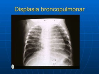 Displasia broncopulmonar 