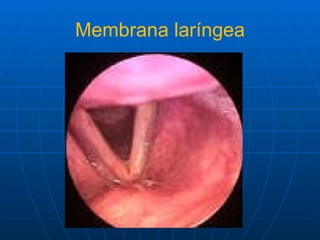 Membrana laríngea 