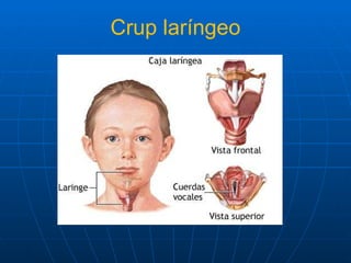 Crup laríngeo 
