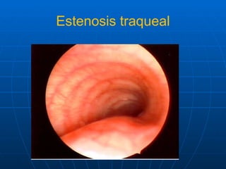 Estenosis traqueal 