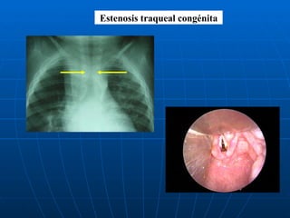 Estenosis traqueal congénita 