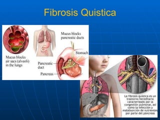 Fibrosis Quistica 