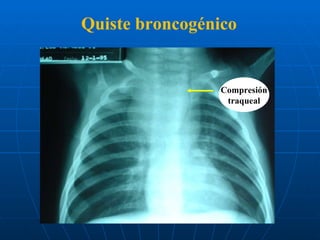 Quiste broncogénico Compresión traqueal 