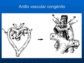 Anillo vascular congénito 