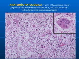 ANATOMÍA PATOLOGICA :  Típica célula gigante como expresión del efecto citopático del virus, con una inclusión  redondeada rosa intracitoplasmática 