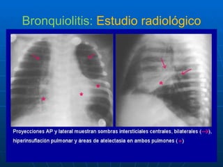 Bronquiolitis:  Estudio radiológico 