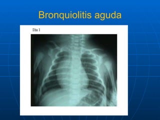 Bronquiolitis aguda 