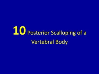 10Posterior Scalloping of a
Vertebral Body
 