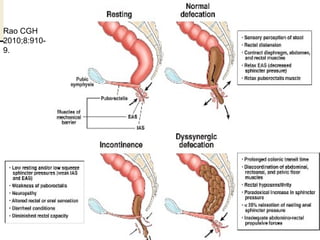 Positional Incontinance 10 settles pelvic floor disorders | PDF