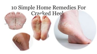 10 Simple Home Remedies For
Cracked Heels
 