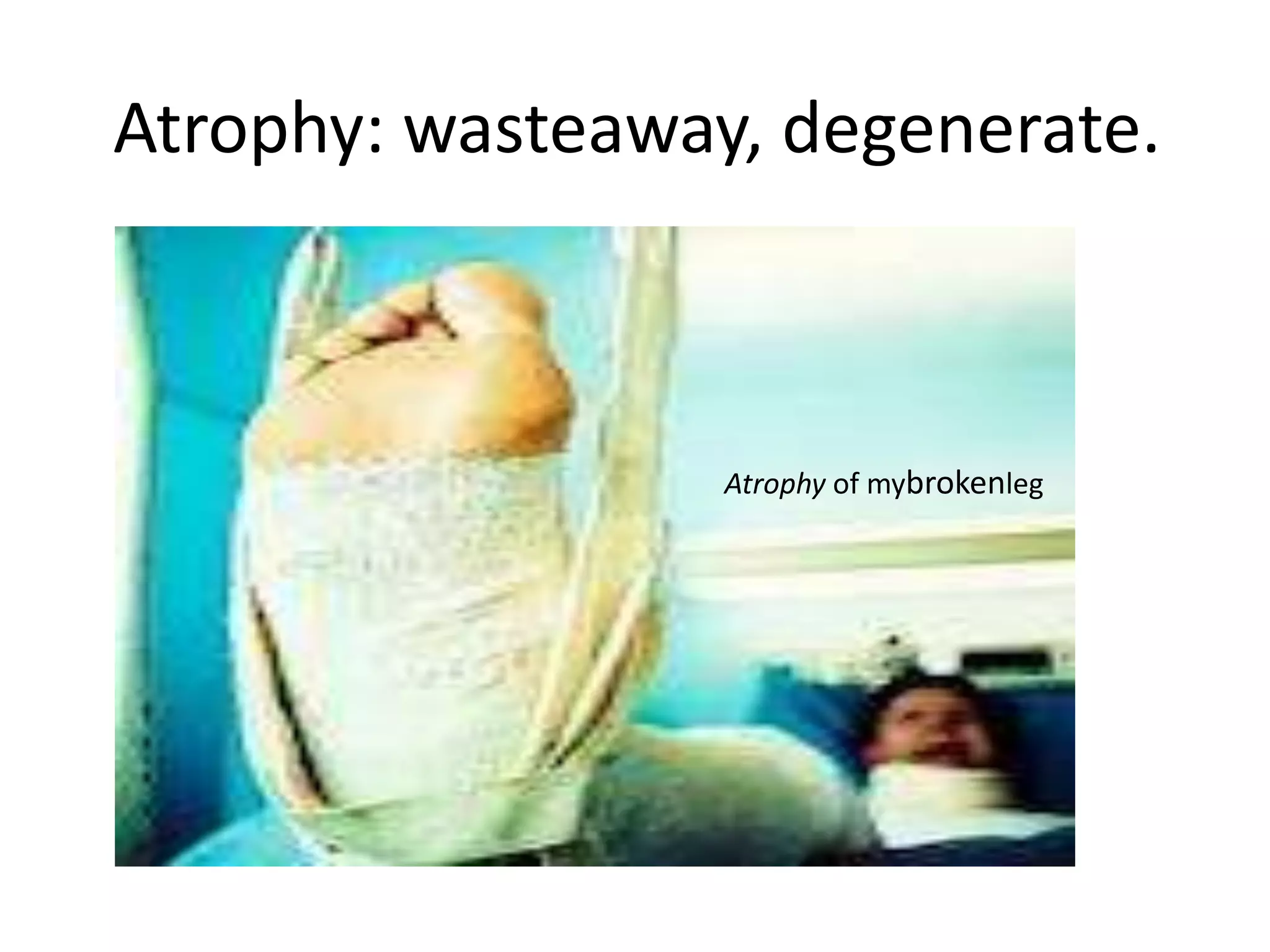 Atrophy: wasteaway, degenerate.



                  Atrophy of mybrokenleg
 