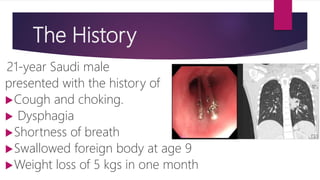 The History
21-year Saudi male
presented with the history of
Cough and choking.
 Dysphagia
Shortness of breath
Swallowed foreign body at age 9
Weight loss of 5 kgs in one month
 