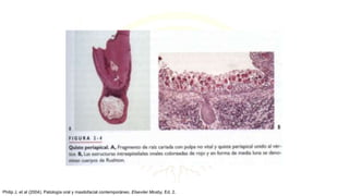 Philip J, et al (2004). Patología oral y maxilofacial contemporáneo. Elseviier Mosby, Ed. 2.
 