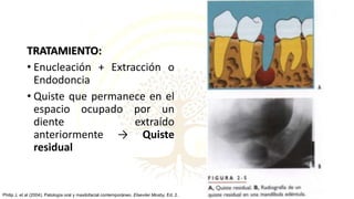 TRATAMIENTO:
• Enucleación + Extracción o
Endodoncia
• Quiste que permanece en el
espacio ocupado por un
diente extraído
anteriormente → Quiste
residual
Philip J, et al (2004). Patología oral y maxilofacial contemporáneo. Elseviier Mosby, Ed. 2.
 