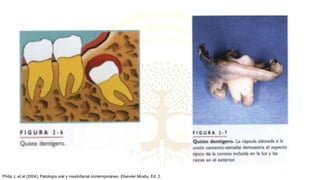 Philip J, et al (2004). Patología oral y maxilofacial contemporáneo. Elseviier Mosby, Ed. 2.
 