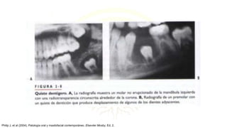 Philip J, et al (2004). Patología oral y maxilofacial contemporáneo. Elseviier Mosby, Ed. 2.
 