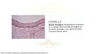 Philip J, et al (2004). Patología oral y maxilofacial contemporáneo. Elseviier Mosby, Ed. 2.
 