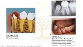 Philip J, et al (2004). Patología oral y maxilofacial contemporáneo. Elseviier Mosby, Ed. 2.
 