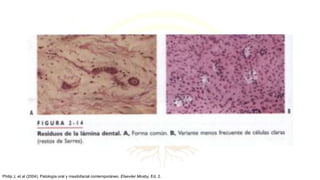 Philip J, et al (2004). Patología oral y maxilofacial contemporáneo. Elseviier Mosby, Ed. 2.
 