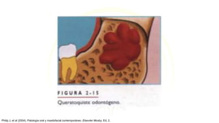 Philip J, et al (2004). Patología oral y maxilofacial contemporáneo. Elseviier Mosby, Ed. 2.
 
