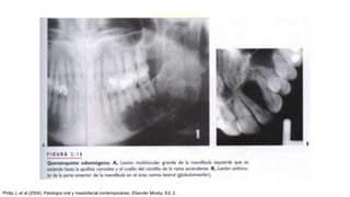 Philip J, et al (2004). Patología oral y maxilofacial contemporáneo. Elseviier Mosby, Ed. 2.
 
