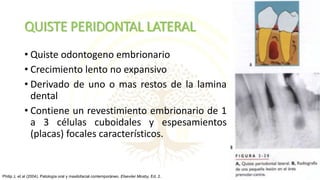 QUISTE PERIDONTAL LATERAL
• Quiste odontogeno embrionario
• Crecimiento lento no expansivo
• Derivado de uno o mas restos de la lamina
dental
• Contiene un revestimiento embrionario de 1
a 3 células cuboidales y espesamientos
(placas) focales característicos.
Philip J, et al (2004). Patología oral y maxilofacial contemporáneo. Elseviier Mosby, Ed. 2.
 