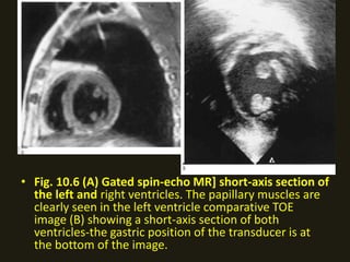 • Fig. 10.6 (A) Gated spin-echo MR] short-axis section of
the left and right ventricles. The papillary muscles are
clearly seen in the left ventricle comparative TOE
image (B) showing a short-axis section of both
ventricles-the gastric position of the transducer is at
the bottom of the image.
 