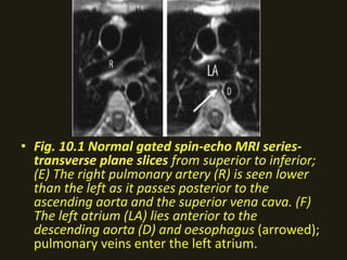 • Fig. 10.1 Normal gated spin-echo MRI series-
transverse plane slices from superior to inferior;
(E) The right pulmonary artery (R) is seen lower
than the left as it passes posterior to the
ascending aorta and the superior vena cava. (F)
The left atrium (LA) lies anterior to the
descending aorta (D) and oesophagus (arrowed);
pulmonary veins enter the left atrium.
 