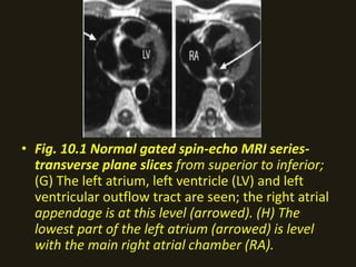 • Fig. 10.1 Normal gated spin-echo MRI series-
transverse plane slices from superior to inferior;
(G) The left atrium, left ventricle (LV) and left
ventricular outflow tract are seen; the right atrial
appendage is at this level (arrowed). (H) The
lowest part of the left atrium (arrowed) is level
with the main right atrial chamber (RA).
 