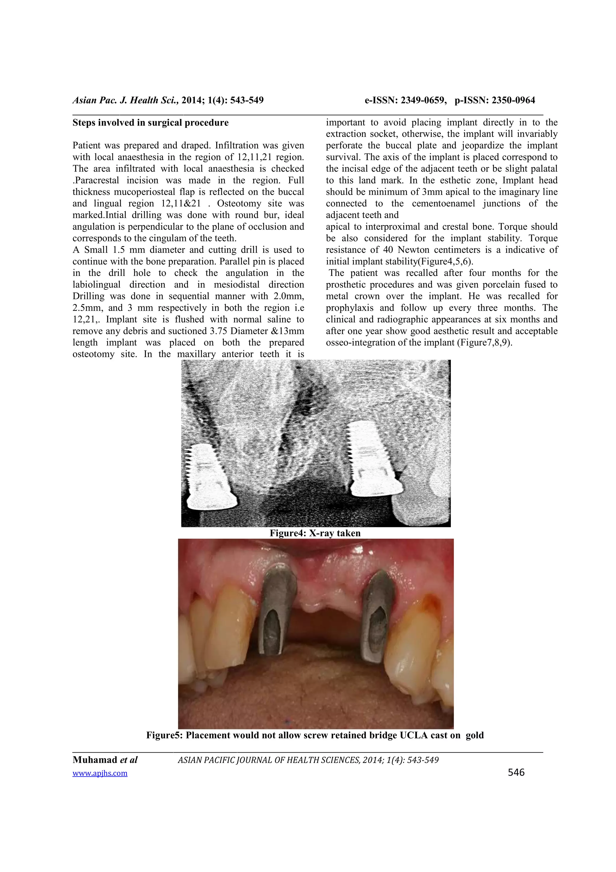 tooth extraction, immediate implant placement a case report | PDF
