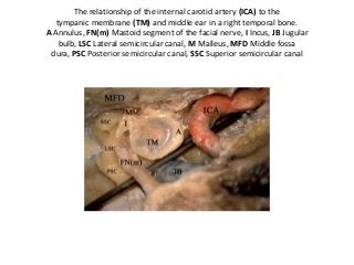 The relationship of the internal carotid artery (ICA) to the
tympanic membrane (TM) and middle ear in a right temporal bone.
A Annulus, FN(m) Mastoid segment of the facial nerve, I Incus, JB Jugular
bulb, LSC Lateral semicircular canal, M Malleus, MFD Middle fossa
dura, PSC Posterior semicircular canal, SSC Superior semicircular canal
 