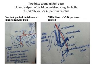 Two bissections in skull base
1. vertical part of facial nerve bisects jugular bulb
2. GSPN bisects V3& petrous carotid
Vertical part of facial nerve
bisects jugular bulb
GSPN bisects V3 & petrous
carotid
 