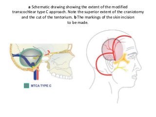 a Schematic drawing showing the extent of the modified
transcochlear type C approach. Note the superior extent of the craniotomy
and the cut of the tentorium. b The markings of the skin incision
to be made.
 