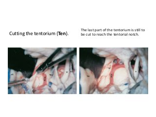 Cutting the tentorium (Ten).
The last part of the tentorium is still to
be cut to reach the tentorial notch.
 