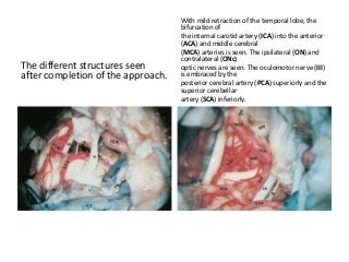The different structures seen
after completion of the approach.
With mild retraction of the temporal lobe, the
bifurcation of
the internal carotid artery (ICA) into the anterior
(ACA) and middle cerebral
(MCA) arteries is seen. The ipsilateral (ON) and
contralateral (ONc)
optic nerves are seen. The oculomotor nerve (III)
is embraced by the
posterior cerebral artery (PCA) superiorly and the
superior cerebellar
artery (SCA) inferiorly.
 