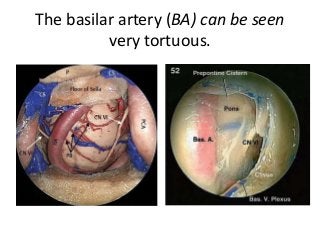 The basilar artery (BA) can be seen
very tortuous.
 