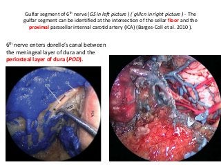 Gulfar segment of 6th nerve (GS in left picture ) ( gVIcn in right picture ) - The
gulfar segment can be identified at the intersection of the sellar floor and the
proximal parasellar internal carotid artery (ICA) (Barges-Coll et al. 2010 ).
6th nerve enters dorello’s canal between
the meningeal layer of dura and the
periosteal layer of dura (POD).
 