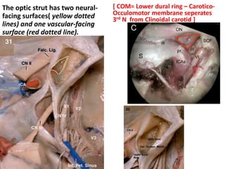Three surgical attachments of the right anterior clinoid process.
(a, sphenoid ridge; b, roof of optic canal; c, optic strut.)
 