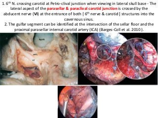 1. 6th N. crossing carotid at Petro-clival junction when viewing in lateral skull base - The
lateral aspect of the parasellar & paraclival carotid junction is crossed by the
abducent nerve (VI) at the entrance of both [ 6th nerve & carotid ] structures into the
cavernous sinus.
2. The gulfar segment can be identified at the intersection of the sellar floor and the
proximal parasellar internal carotid artery (ICA) (Barges-Coll et al. 2010 ).
 
