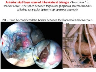 Anterior skull base view of Inferolateral triangle -“Front door” to
Meckel’s cave – the space between trigeminal ganglion & laceral carotid is
called quadrangular space – suprapetrous approach
PLL - It can be considered the border between the horizontal and cavernous
portions of the internal carotid artery.
 