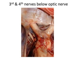 1. SOF present between two structs
2. OS [ optic struct separates optic canal from SOF ]
 
