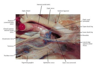 SOF & IOF are in C-shape when you
see through orbit /maxilla/nose
 