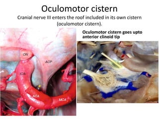 The lower dural ring is given by the COM, that lines the inferior surface of the ACP. It
can be visible, through a transcranial route, only by removing the ACP. The lower dural
ring is also called Perneczky’s ring. Medially the COM blends with the dura that lines
the carotid sulcus (Yasuda et al. 2005 )
Endoscopic supraorbital view of the anterior clinoid region. The right
portion of the planum sphenoidale is seen from above. The anterior clinoid process
has been removed. Vision obtained through a right supraorbital approach with a 30°
down-facing lens focusing on the cavernous sinus roof.
ACP anterior clinoid process (removed), COM carotid oculomotor membrane, ICAc
cavernous portion of the internal carotid artery, ICAi intracranial portion of the
internal carotid artery, OA ophthalmic artery, ON optic nerve, LWS lesser wing of the
sphenoid, IIIcn oculomotor nerve
 