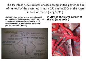 COM = carotico–oculomotor
membrane
Superior view of the right
ophthalmic artery in the right paraclinoid area. The anterior
clinoid process, which is situated on the lateral side of the
optic nerve, has been removed. The optic canal has been
unroofed, the optic sheath opened, and the optic nerve elevated
to expose the origin of the ophthalmic artery under the
medial half of the optic nerve. In the optic canal, the ophthalmic
artery courses within the dural sheath of the optic
nerve. It exits the optic canal and the optic sheath to enter the
orbital apex on the inferolateral aspect of the optic nerve.
The oculomotor nerve courses just below the dura covering
the lower margin of the anterior clinoid process. The clinoid
segment of the internal carotid artery is the segment that
courses on the medial side of the anterior clinoid process and
is exposed by removing the anterior clinoid process. The
upper edge of the clinoid segment is defined by a dural ring,
called the upper dural ring, formed by the dura, which
extends medially from the upper surface of the anterior clinoid
process. The lower edge of the clinoid segment is
defined by the lower dural ring, which is formed by the dura
that line1 the lower surface of the anterior clinoid process and
separates the clinoid process from the upper surface of the
oculomotor nerve and continues medially as the carotid-
oculomotor membrane to surround the carotid artery The
ophthalmic
artery usually arises just above the clinoid segmenl
However, it may infrequently arise from the clinoid segment.
 