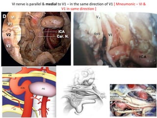 L-OCR – Triangle
1. Upper boarder – Optic nerve & Opthalmic artery
2. Posterior boarder – Clinoidal carotid
3. Lower boarder – 3rd N. [ COM – Carotico-Occulomotor
membrane seperates 3rd N from Clinoidal carotid ]
[ 6th N. & 4th N. & V1 present inferior to 3rd N. ]
 